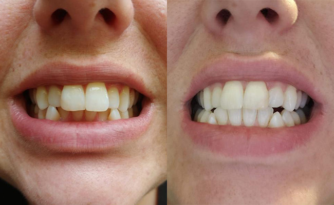 Crest Whitening Emulsions Before After 2